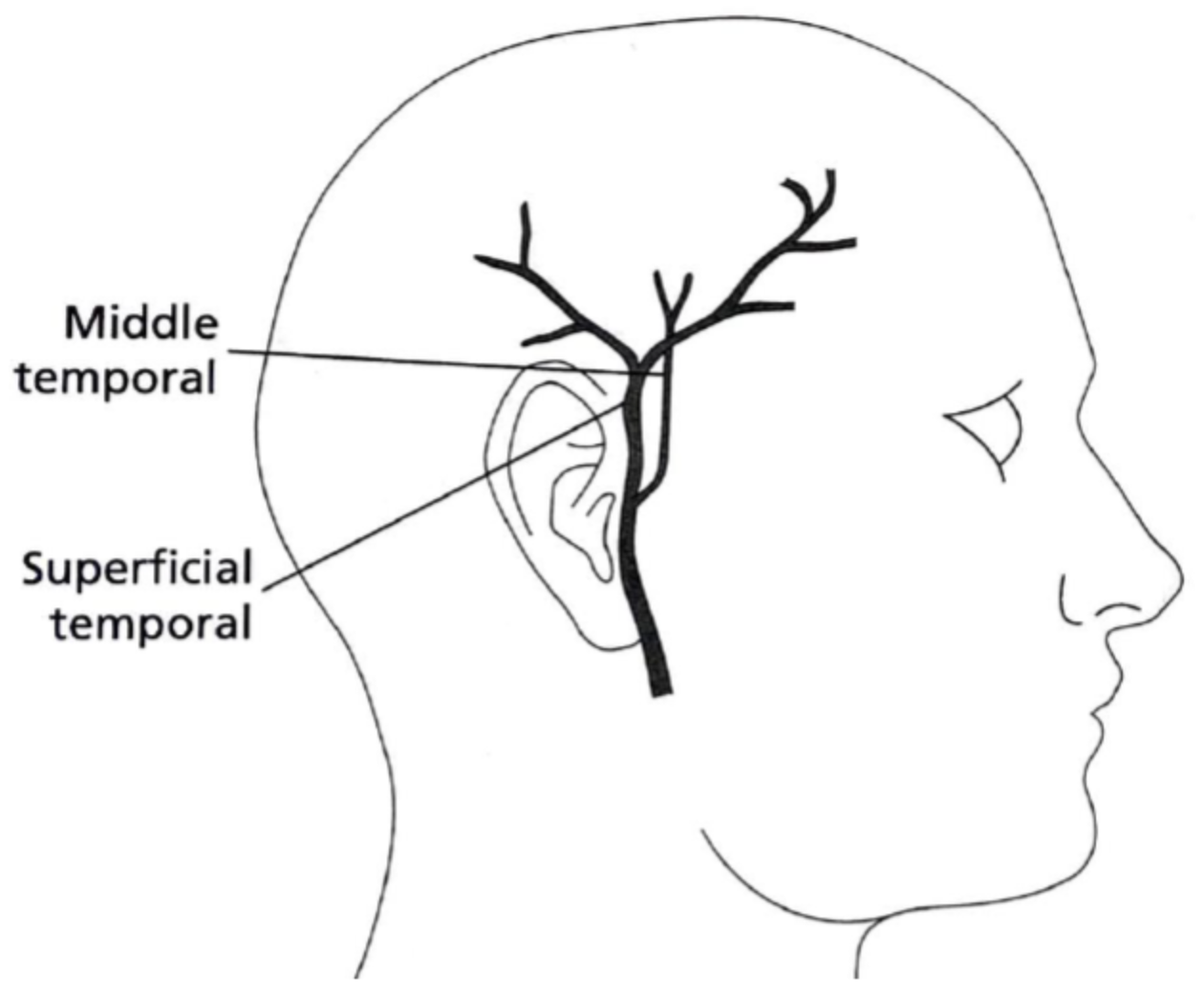 Temporal Artery Biopsy